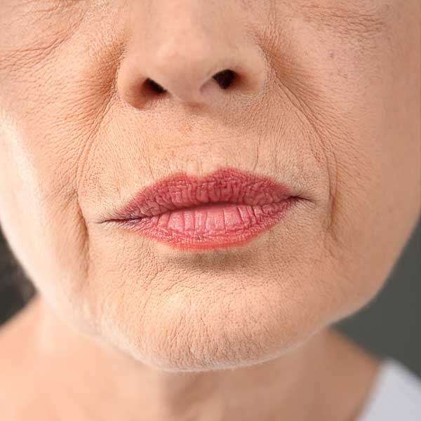 Deep mouth, chin, and neck wrinkles