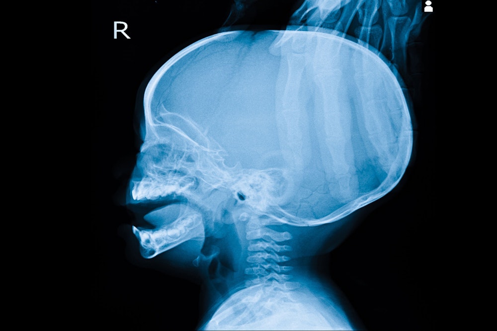 Baby skull fracture xray