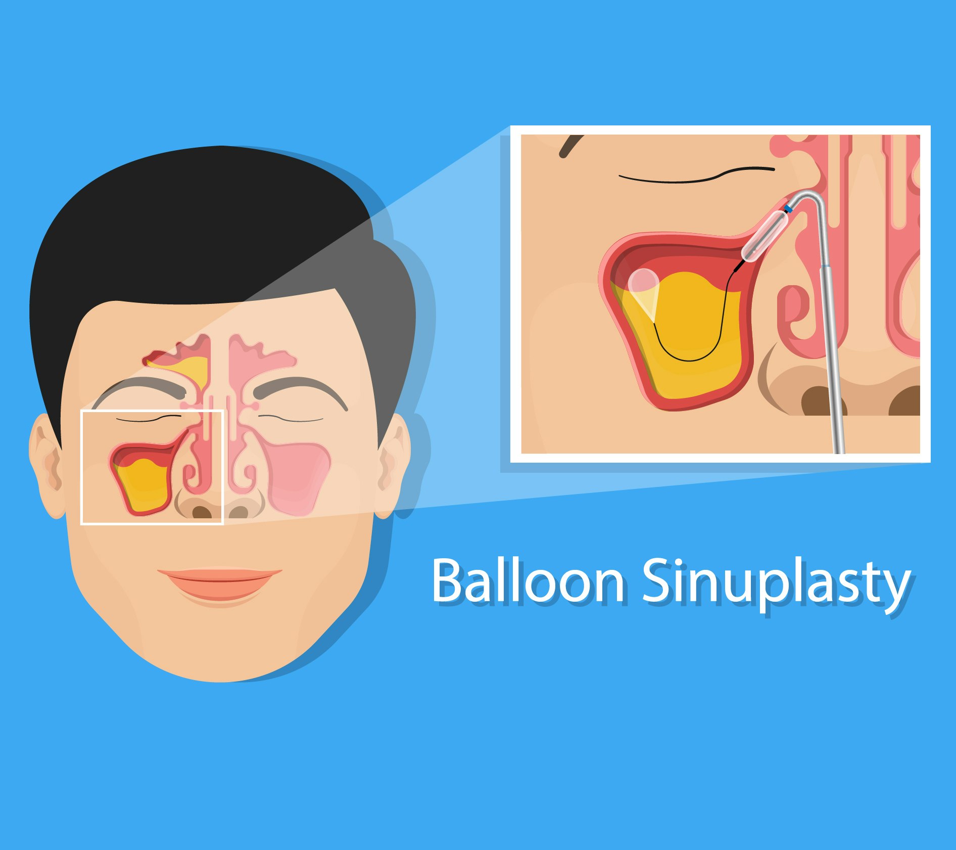 Illustration of balloon sinuplasty