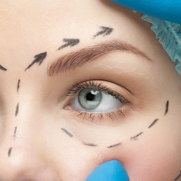 Brow Lift