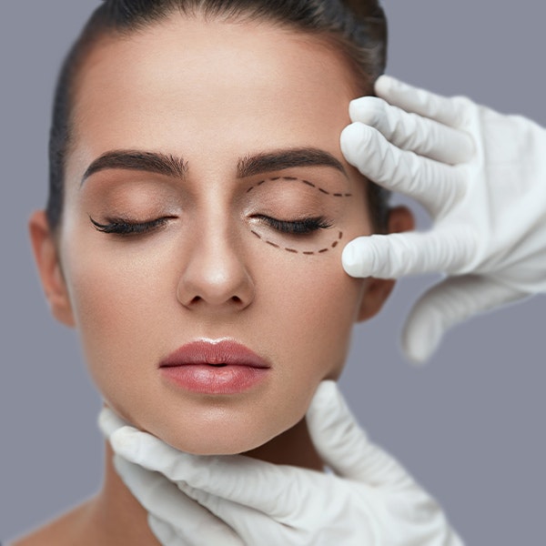 Woman with blepharoplasty lines drawn on upper and lower eyelids