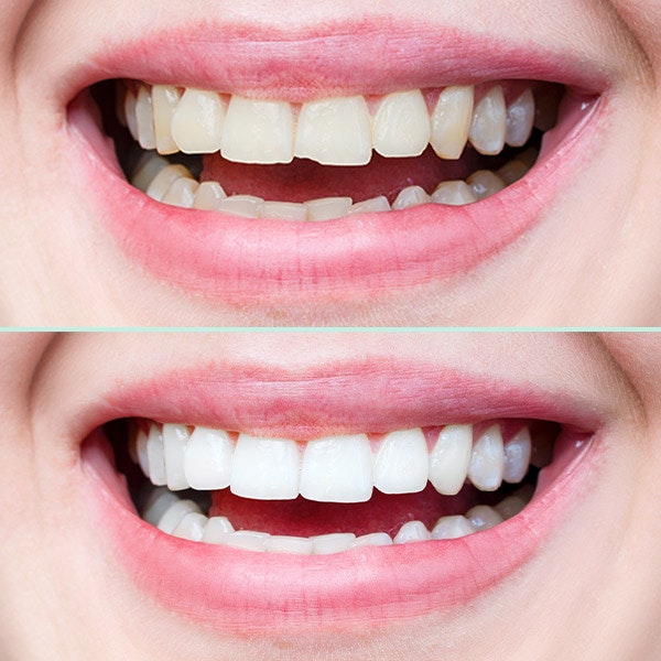 Before and after dental bonding