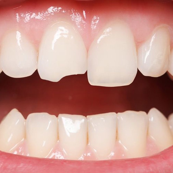 Close up of chipped teeth