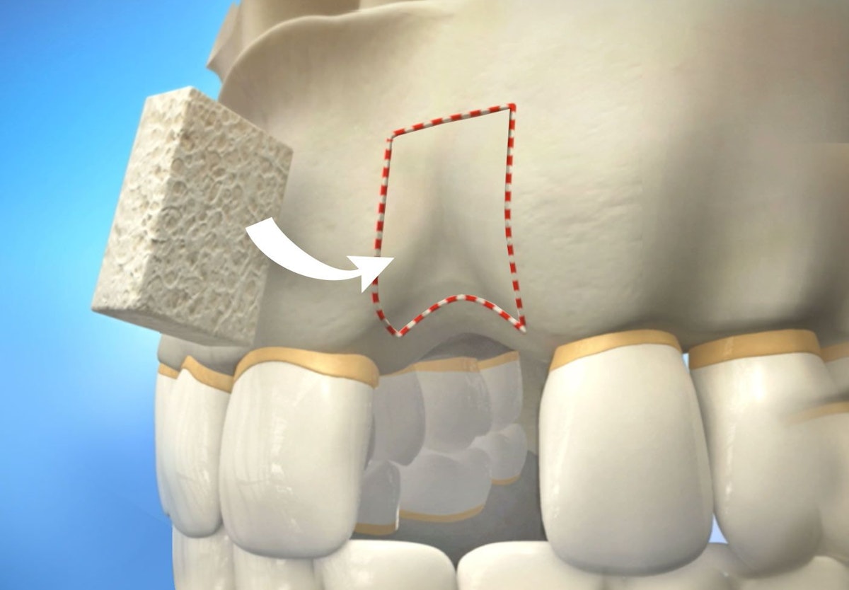 Structural Autograft Bone Grafting Saratoga Springs, UT - Orem, UT - Utah Valley Oral and ...