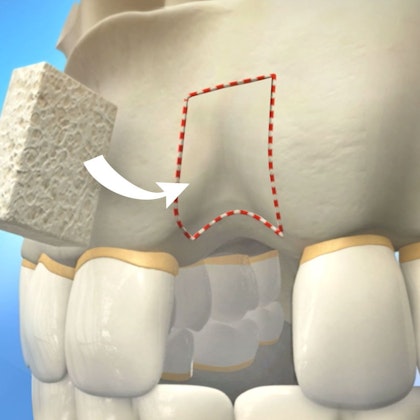 Illustration of bone graft procedure