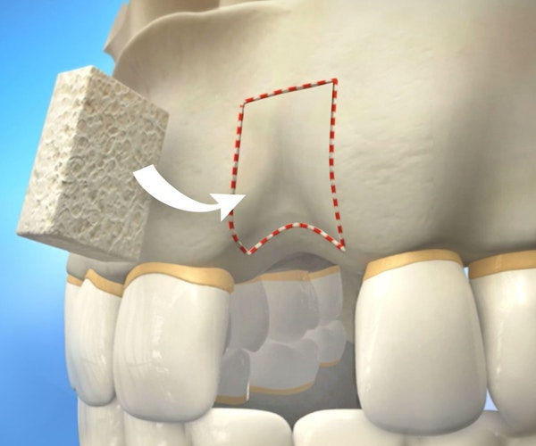 Illustration of bone graft