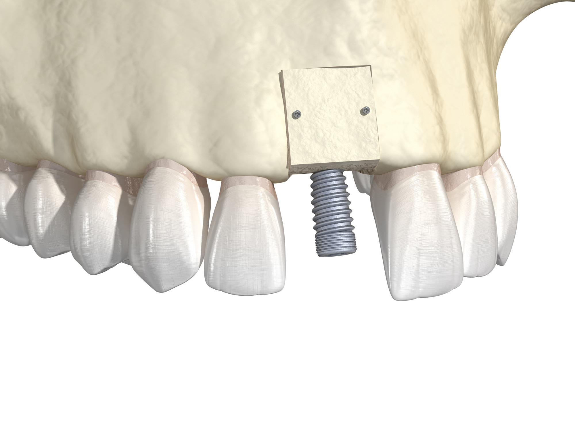 Illustration of bone grafting