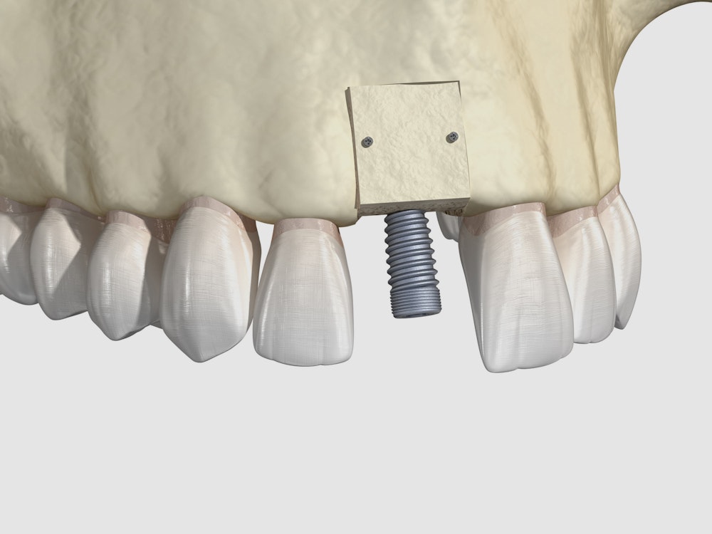 Bone grafting illustration