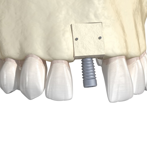 Illustration of bone grafting
