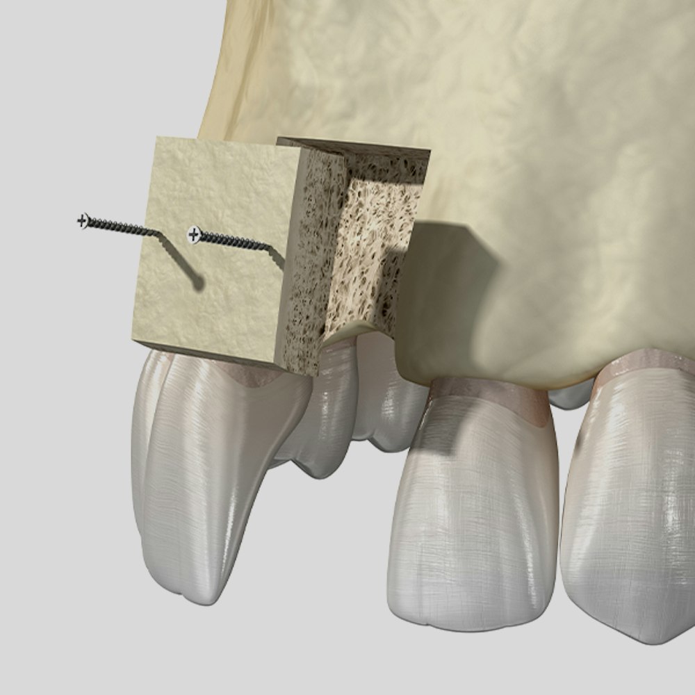 Bone graft diagram