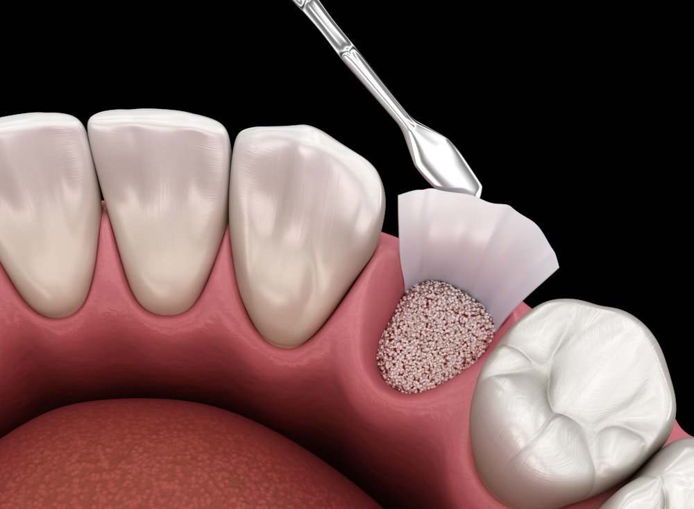 socket graft
