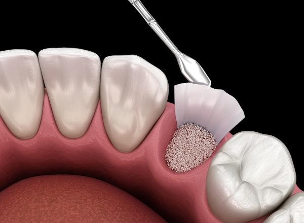 Illustration of bone grafting