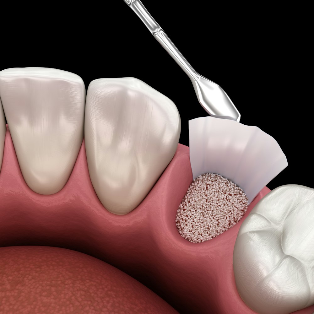 socket graft