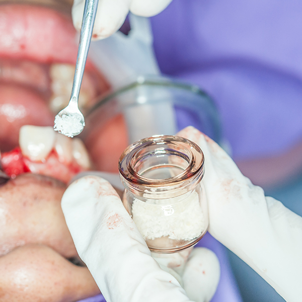 Closeup of bone graft material