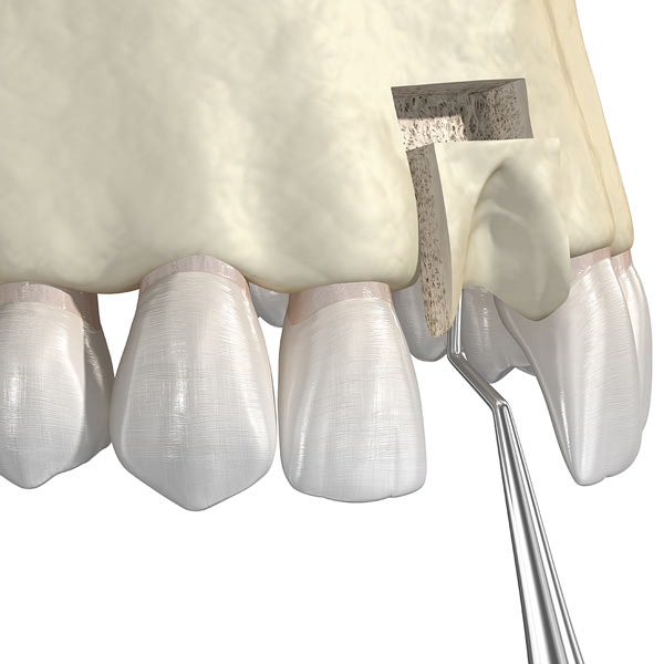 Bone Grafting