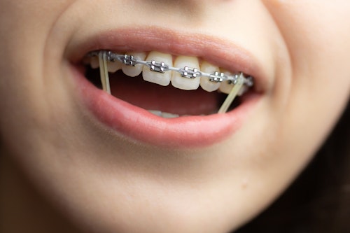 Patient with braces