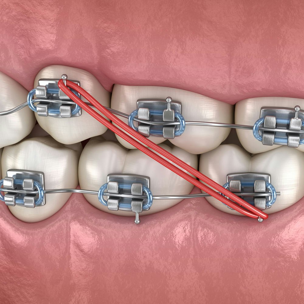 Illustration of braces attachments