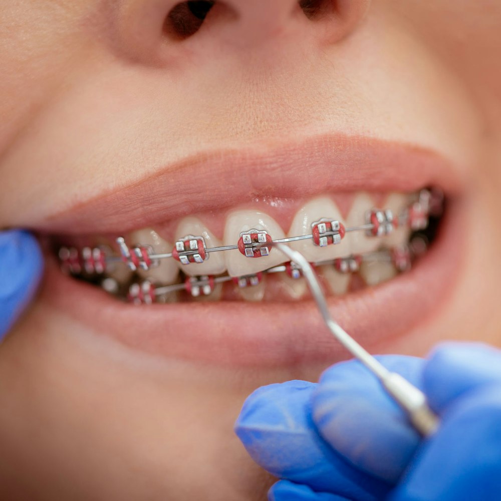 Woman getting rubber bands adjusted on braces