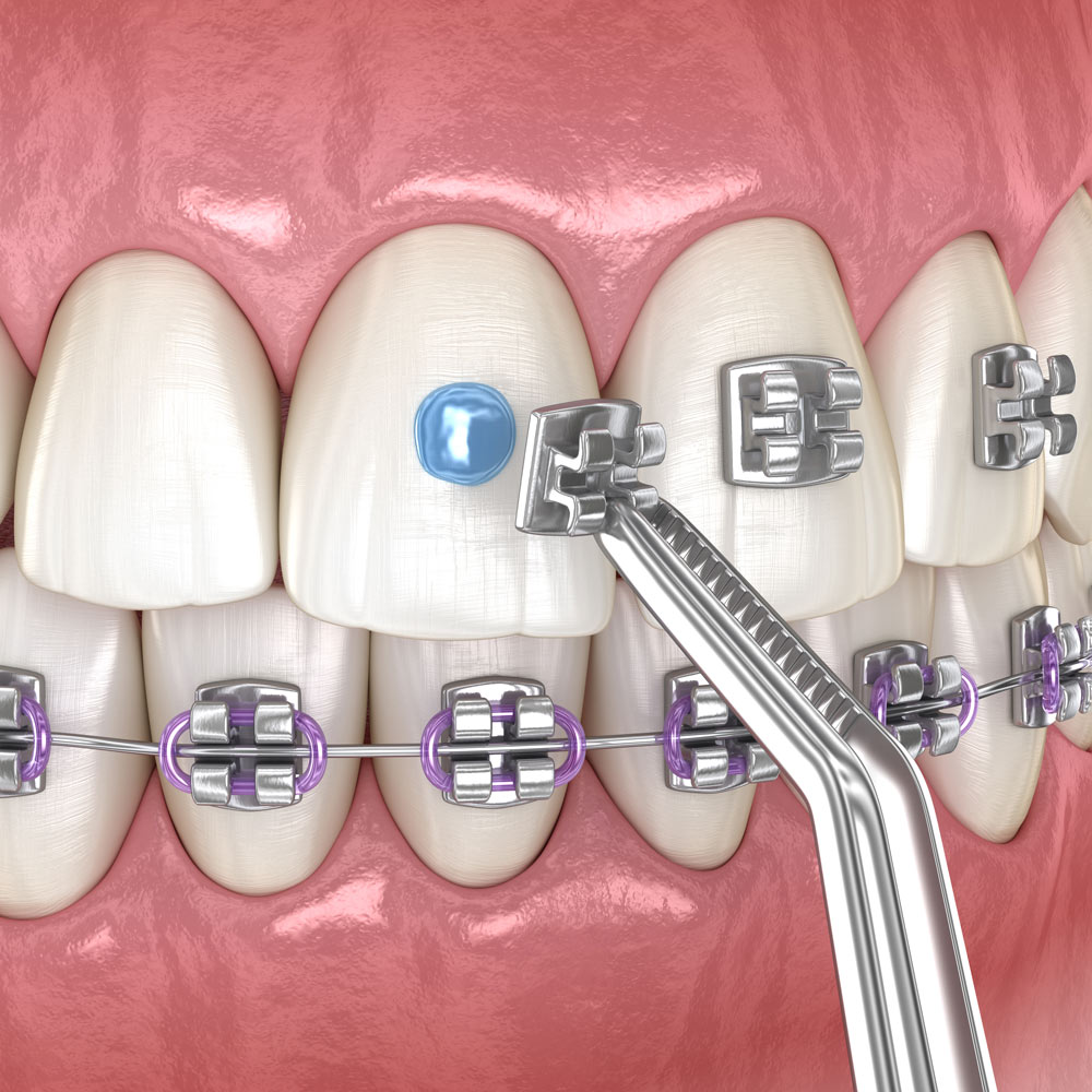 Illustration of braces brackets glued onto teeth
