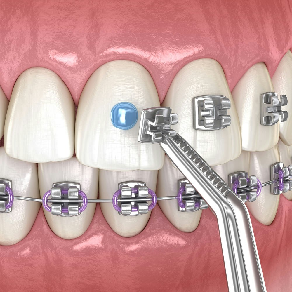 Illustration of braces brackets glued onto teeth
