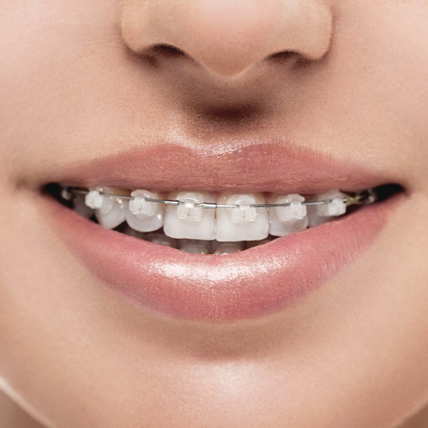 Smile Solutions Dental Anonas - CERAMIC BRACES Also known as clear braces,  are orthodontic tools used to straighten teeth and fix bite problems. They  consist of clear or tooth-colored ceramic brackets attached