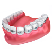 bottom teeth with braces