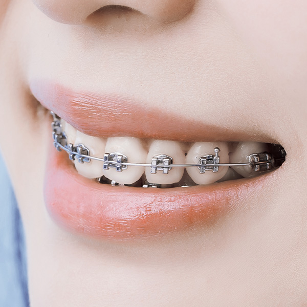 Invisible braces - Invisalign - Invisible dental pin - ExpertDent