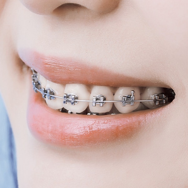 Traditional Braces