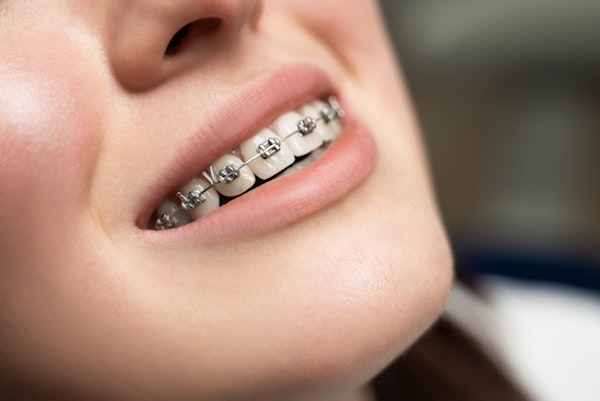 metal braces