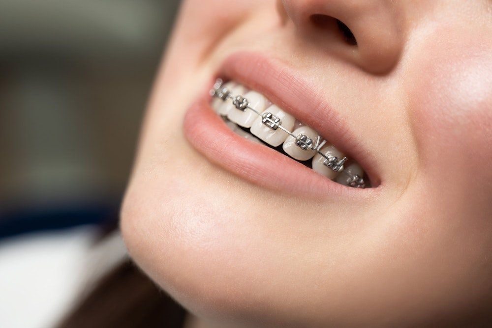 Woman with braces