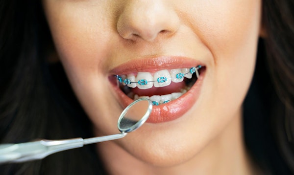Close up of teenager's blue colored braces