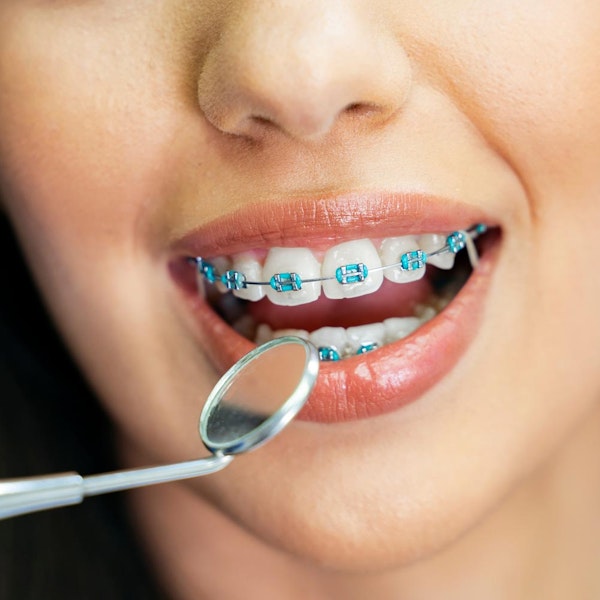 Close up of teenager's blue colored braces