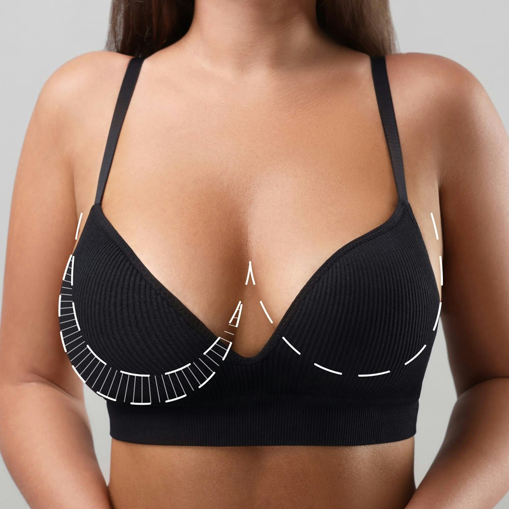 Black bra over breast reduction before and after diagram