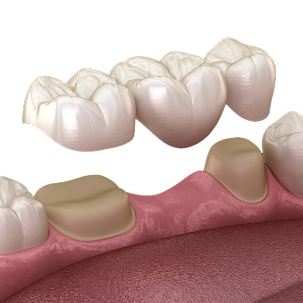 Dental bridge