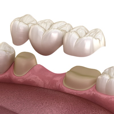 Traditional Dental Bridge