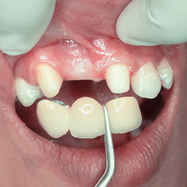 Dental bridge being placed