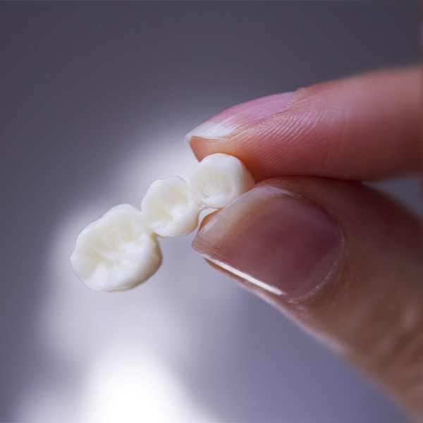 dental bridge
