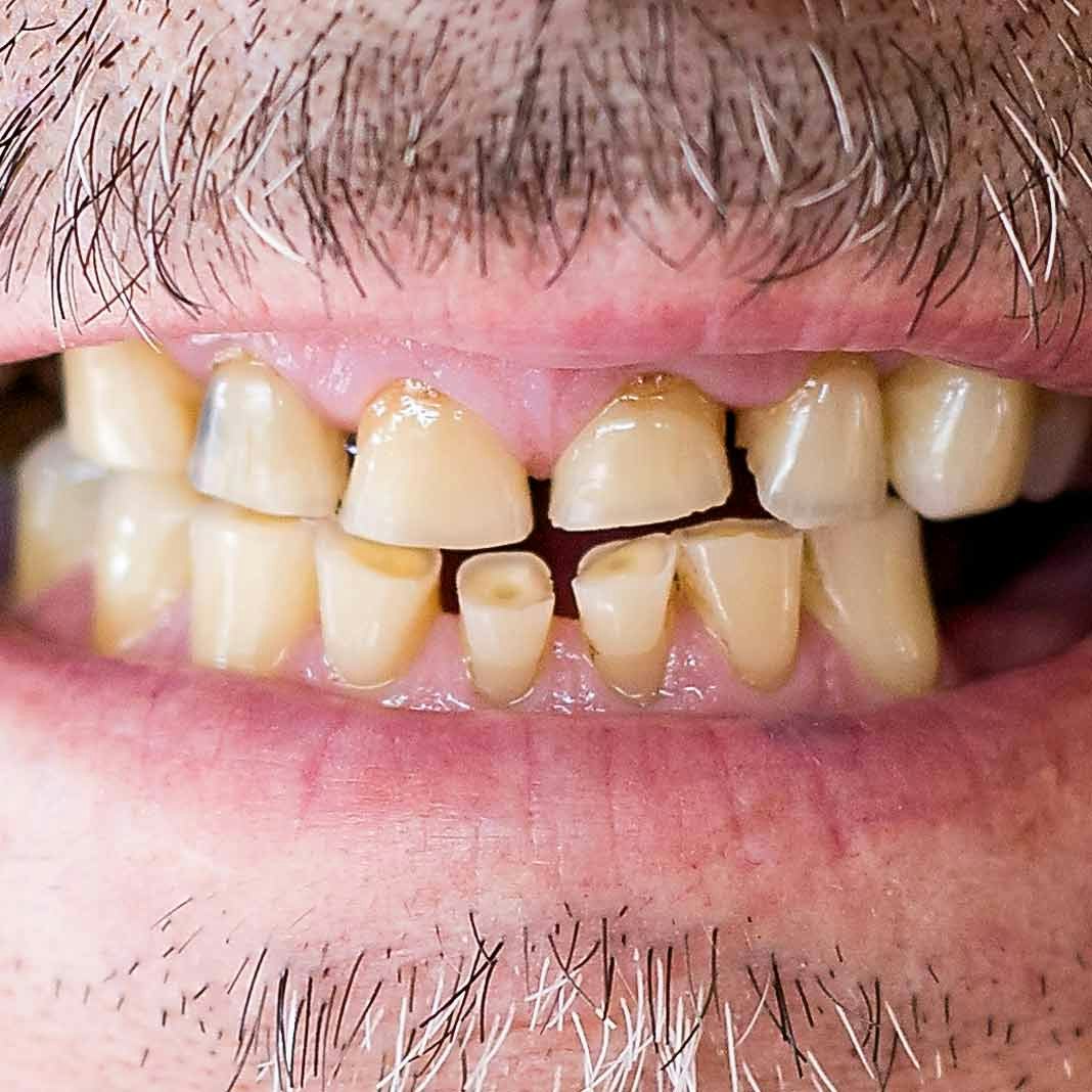 Bruxism