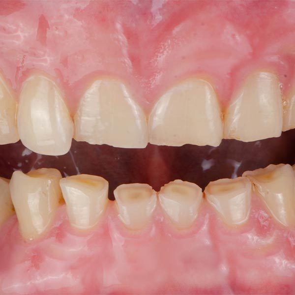 Close up of bruxism