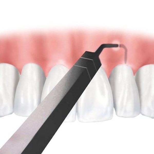 Illustration of Pinhole surgical technique