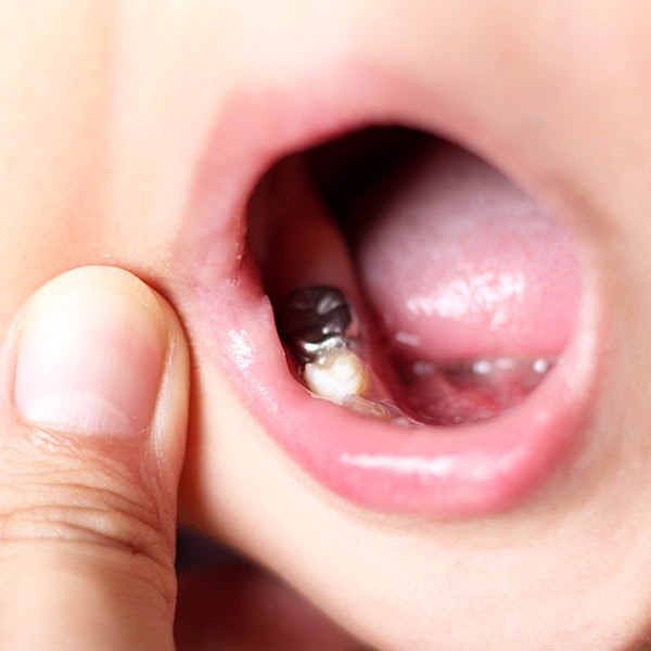 Stainless Steel Crowns