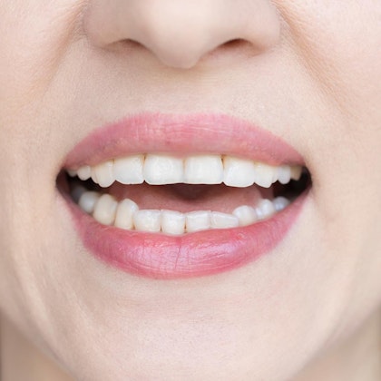 Woman's smile after dental bonding