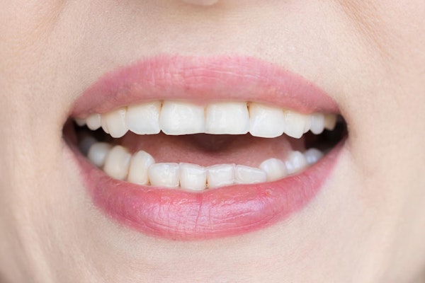 Chipped tooth in need of dental bonding