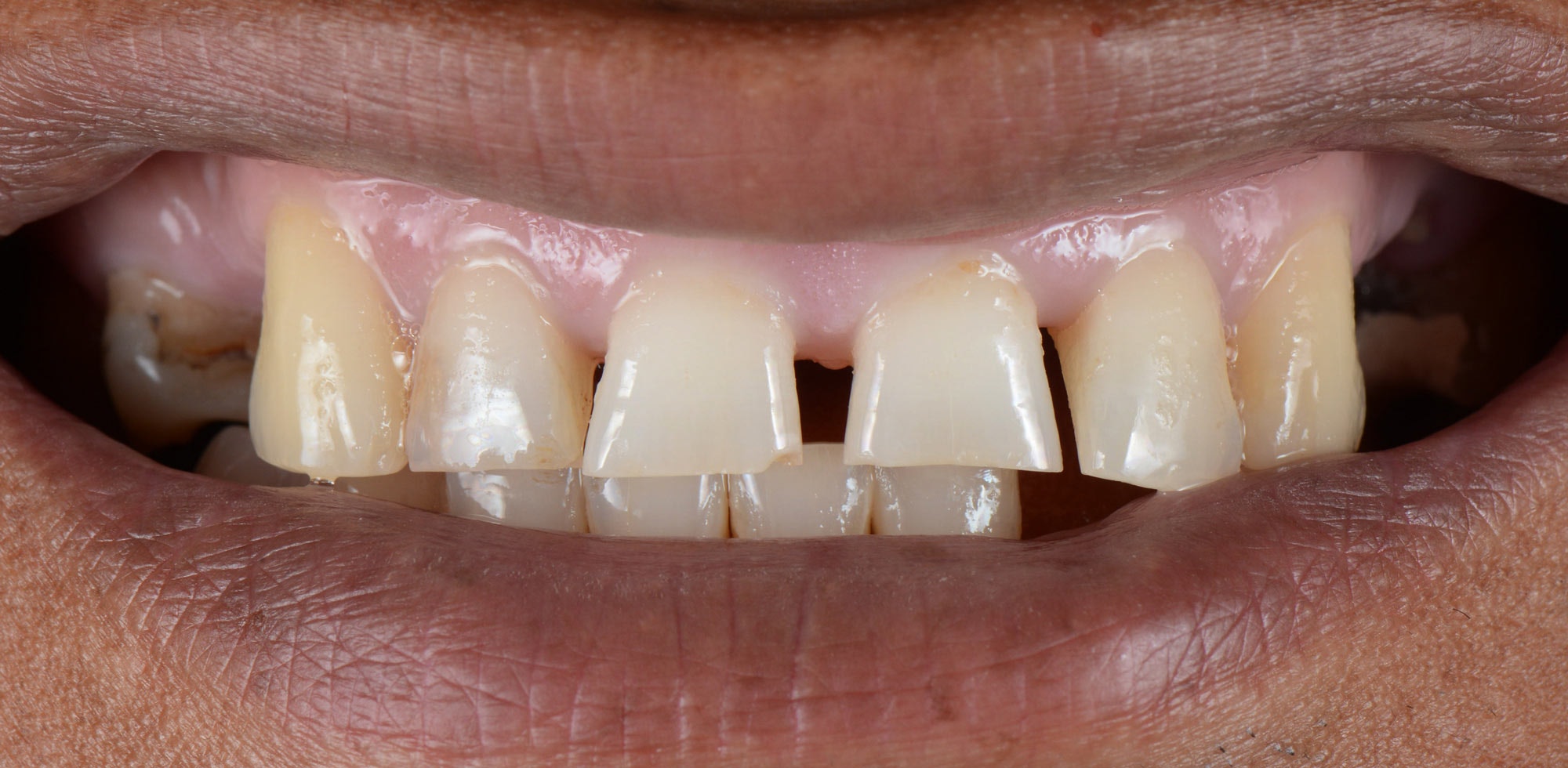 Before cosmetic dentistry