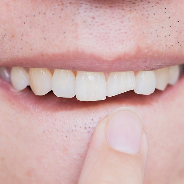 Patient pointing to chipped tooth