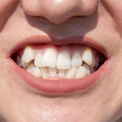 misaligned teeth