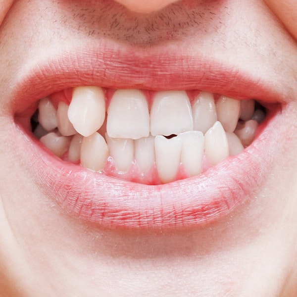 Overcrowded teeth