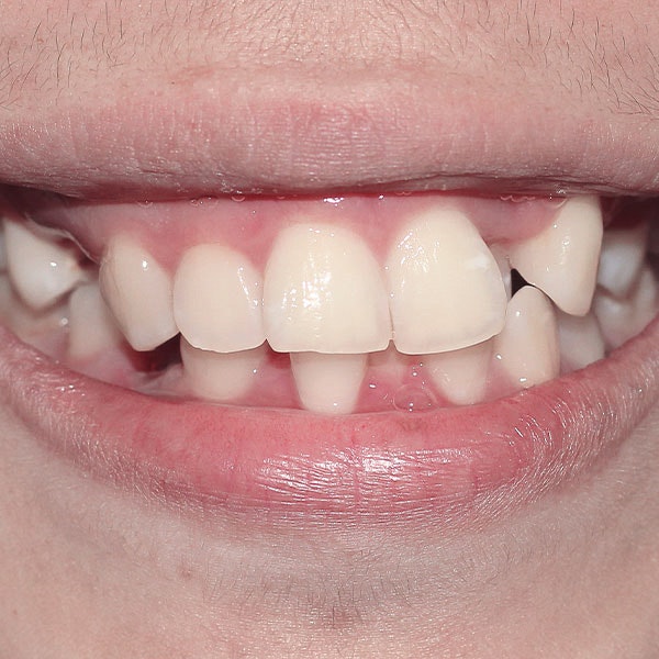 Misaligned teeth