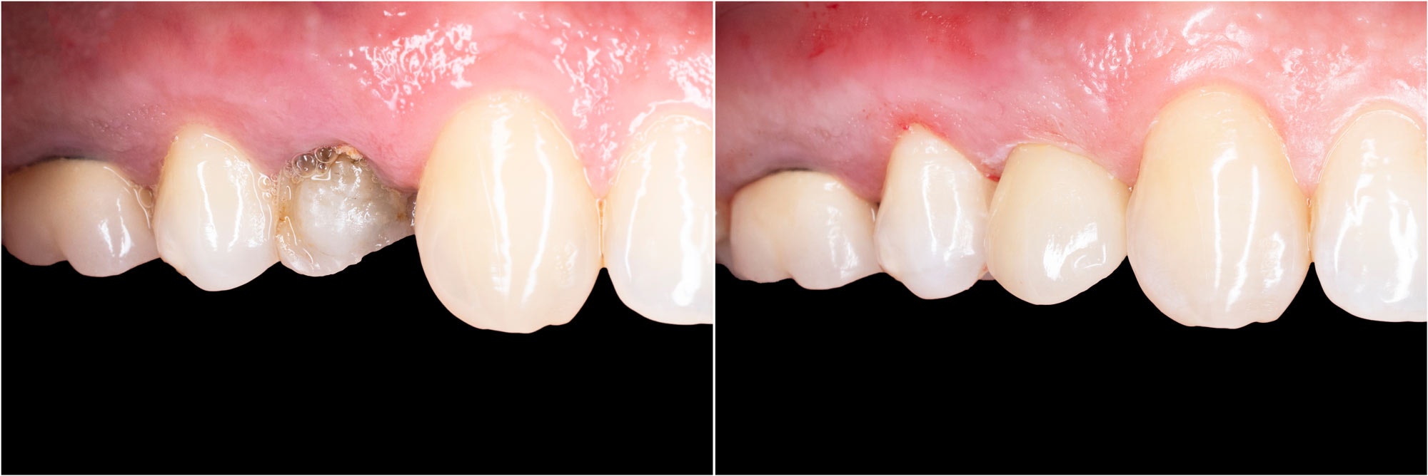 Lake Area Dentistry patient with severely damaged teeth and after treatment