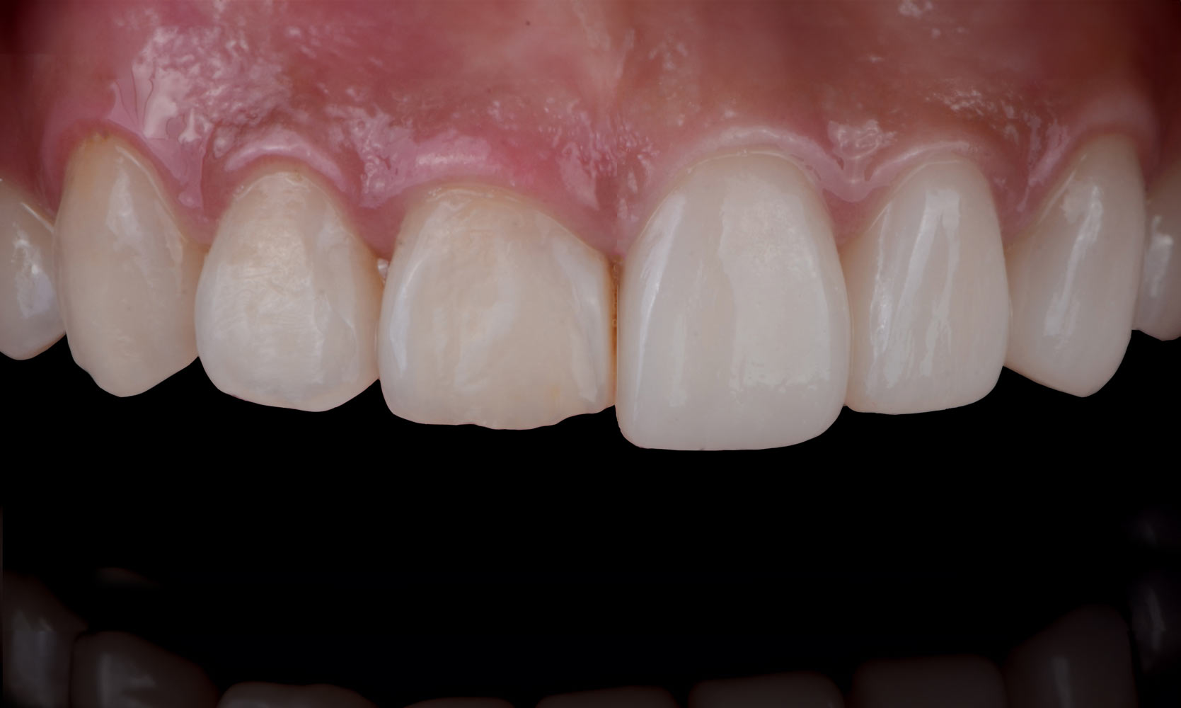 before and after Crown lengthening